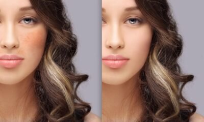 Hydroquinone Cream
